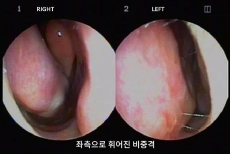 [코비쥬의원] 비중격 교정 전 코 내부 상태를 확인한 사진