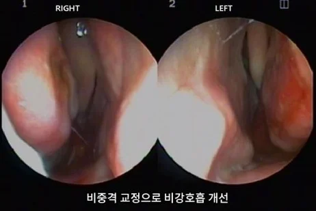 [코비쥬의원] 비중격 교정 후 비강 호흡 상태를 확인한 사진