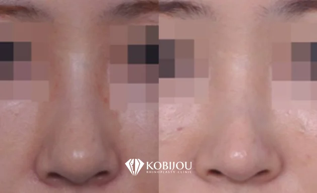 [코비쥬의원] 흉살로 인한 코 재수술 전후 정면 비교 사례 이미지