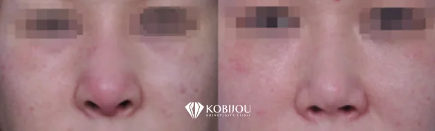 [코비쥬의원] 보형물 감염으로 제거 후 염증 치료를 거쳐 1년 뒤 재수술한 전후 사례 이미지