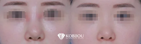 [코비쥬의원] 보형물 감염으로 제거 후 염증 치료를 거쳐 4개월 뒤 재수술한 전후 사례 이미지