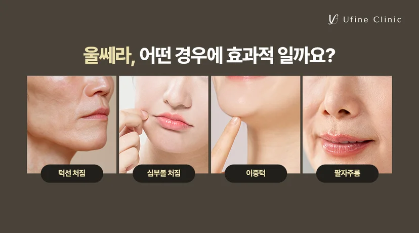 불당동피부과 유파인의원 울쎄라피 프라임 리프팅 추천 대상
