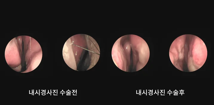 [코비쥬의원] 비밸브 협착과 비중격 만곡 교정 전후 코 내부 상태를 촬영한 실제 내시경 사진