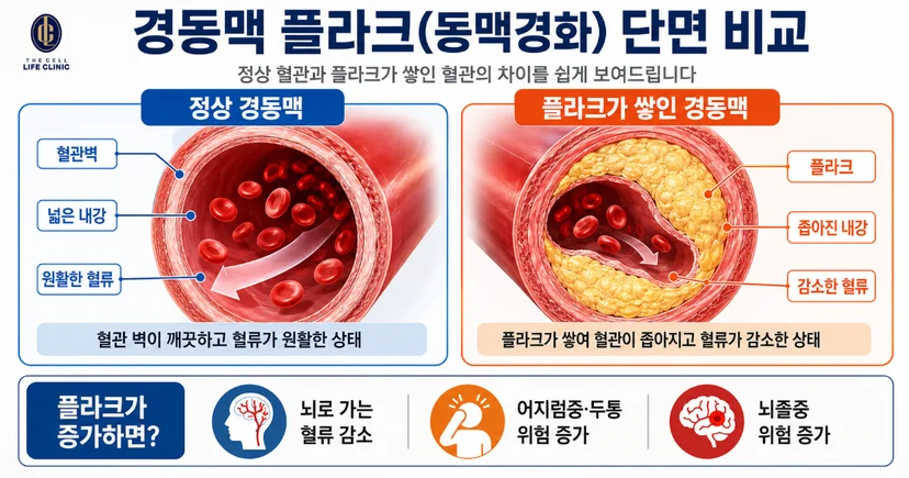경동맥 내중막두께 IMT 동맥경화 진행 단계 인포그래픽, 정상혈관과 플라크가 쌓인 혈관의 차이점을 그림을 보여드립니다. 