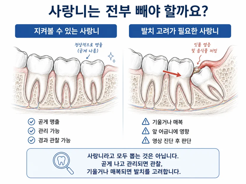 정상적으로 맹출한 사랑니와 앞 어금니 쪽으로 기울어 매복된 사랑니의 단면 비교 일러스트
