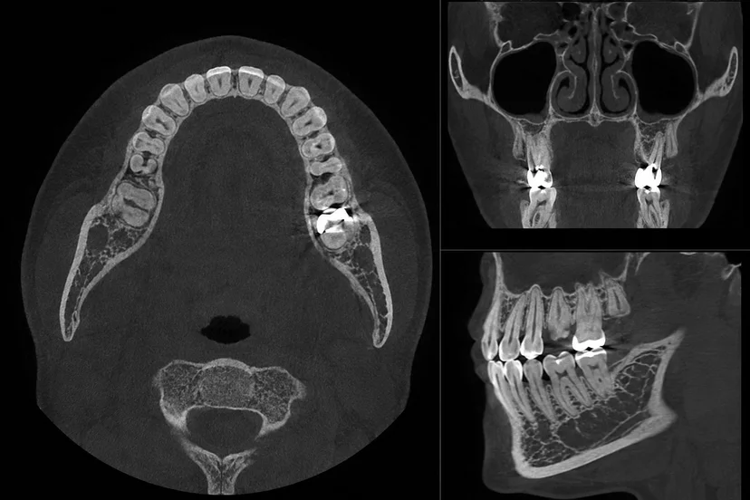 3D-CT-치근파절-진단-vertical-root-fracture-자연치아보존-발치판단