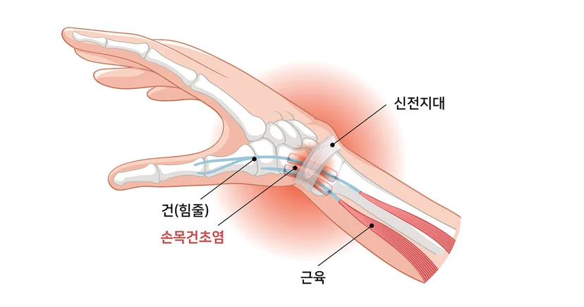 엄지손가락과 손목을 잇는 힘줄 및 건초에 발생한 마찰과 염증 등 손목건초염의 발병 원인과 주요 증상을 알기 쉽게 보여주는 해부학적 이미지