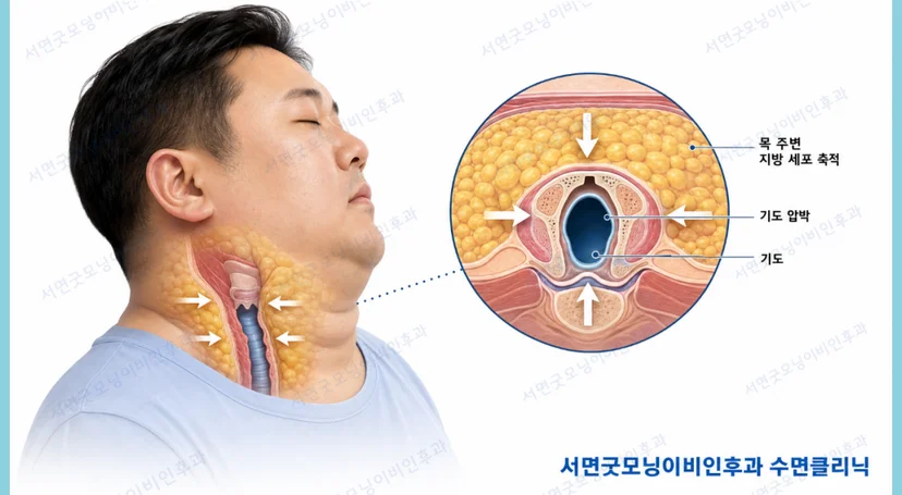 비만과 기도 상태