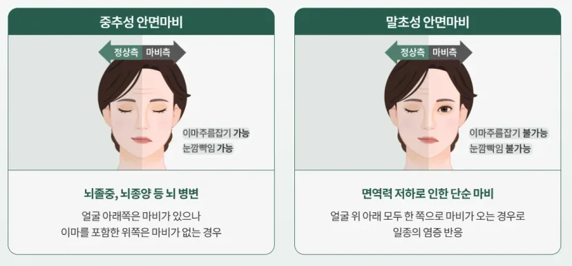 구안와사 골든타임|중추성 및 말초성 안면마비의 증상 차이 비교 인포그래픽