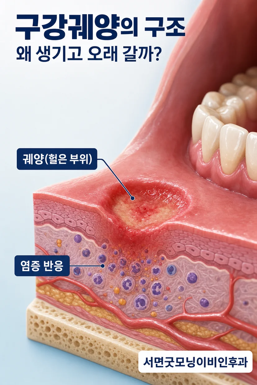 구강궤양의 다양한 원인
