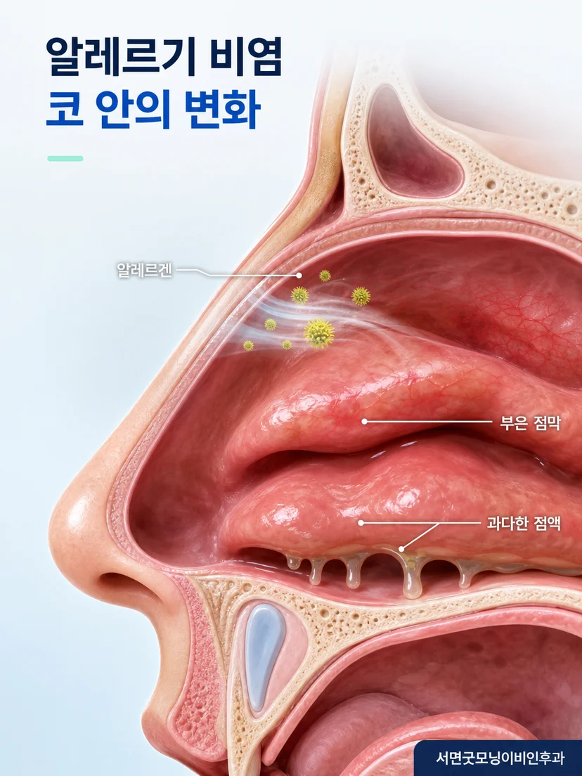알레르기 유발 물질과 비강 점막 반응을 보여주는 개념도