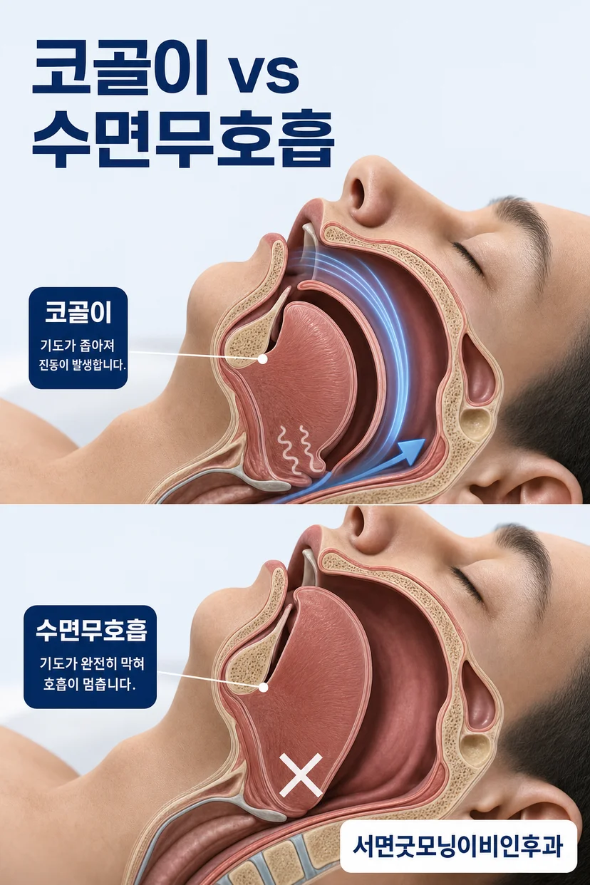 수면무호흡증 환자의 낮 졸림