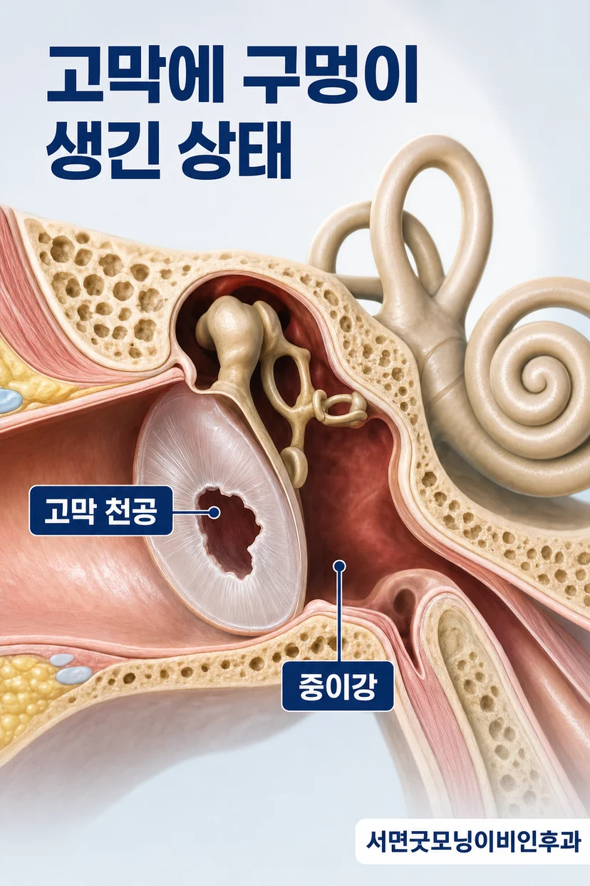 고막천공 환자의 청력검사