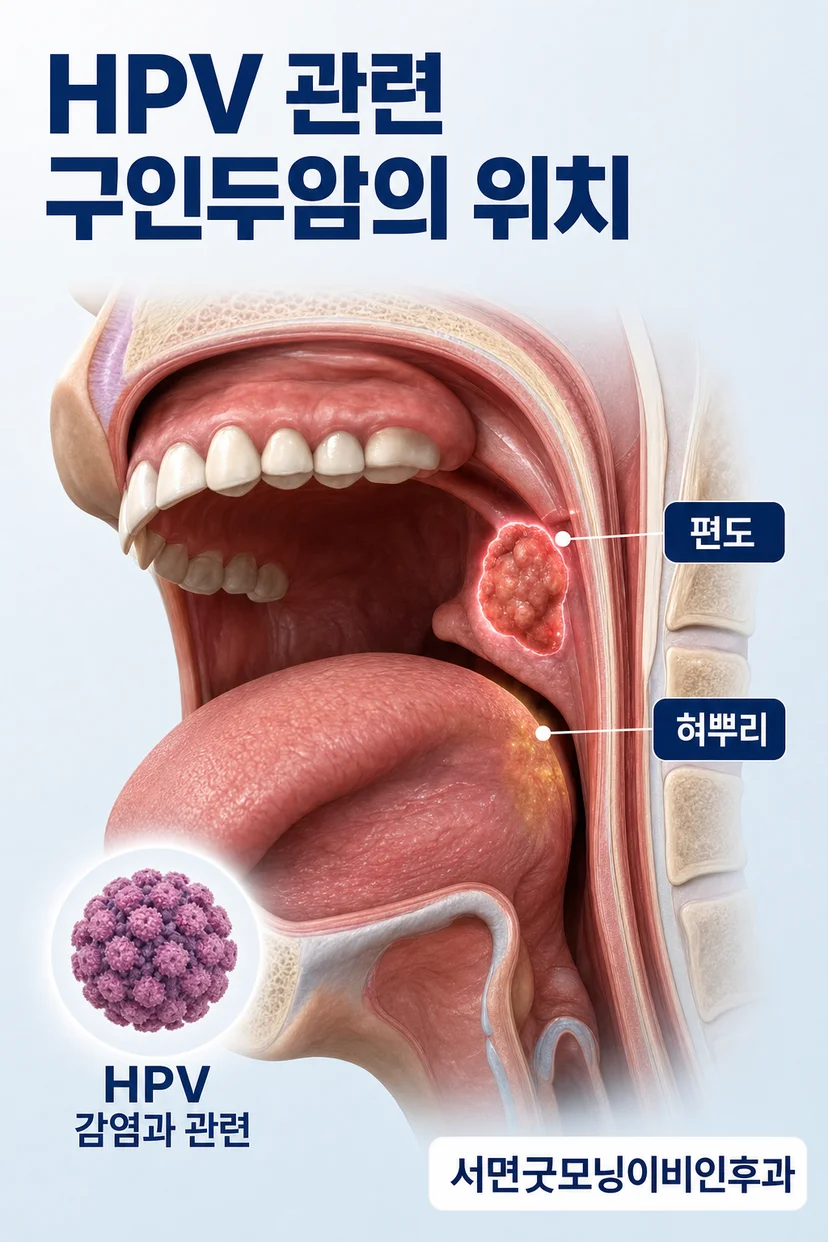 목 림프절 종대와 구인두암의 관계