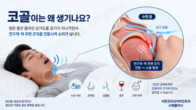 잠든 사람의 코와 입 주변으로 공기가 흐르며 목 안쪽 조직이 진동하는 모습
