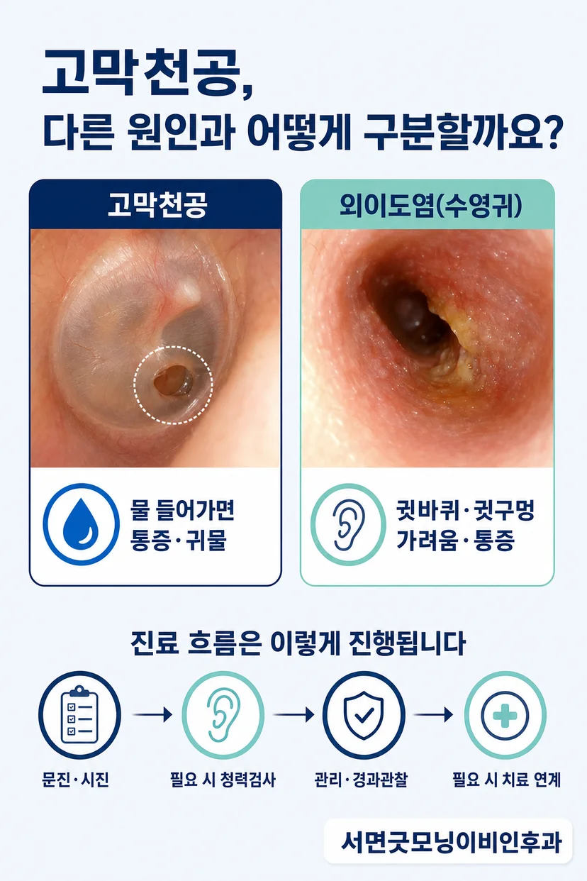 고막천공의 위치와 크기 비교