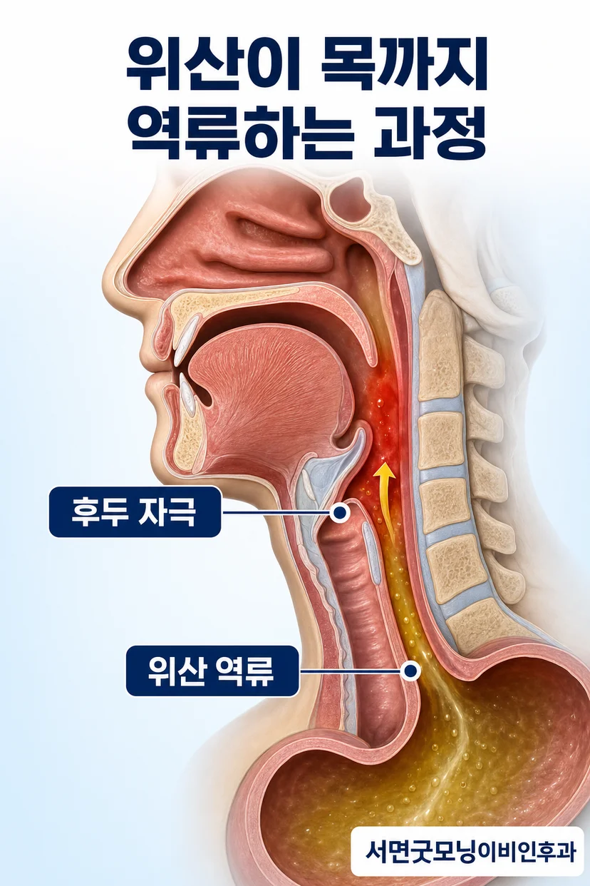 여러 원인에 의한 인후두 자극 이미지