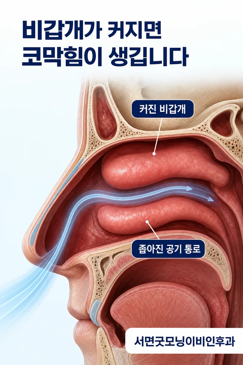 비갑개 비대의 다양한 원인을 설명하는 일러스트