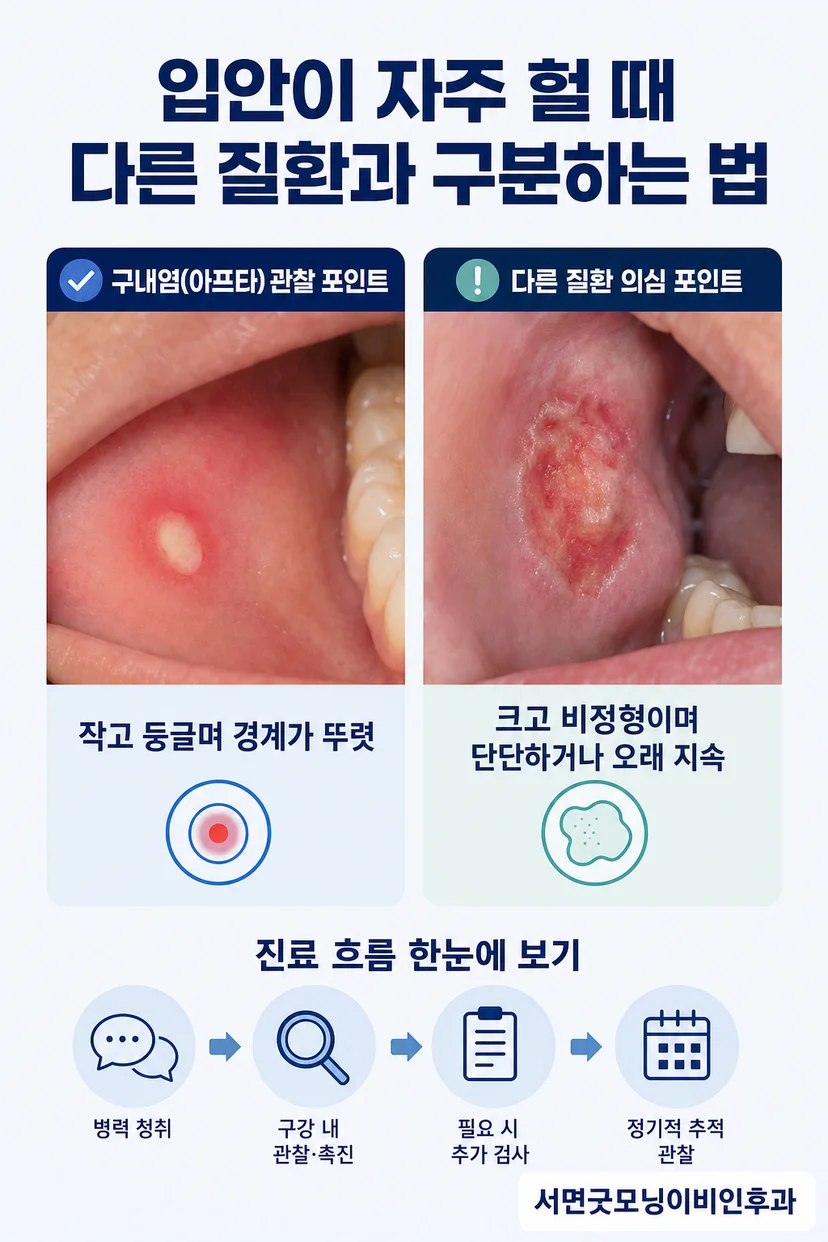 비정형 구강궤양 사진