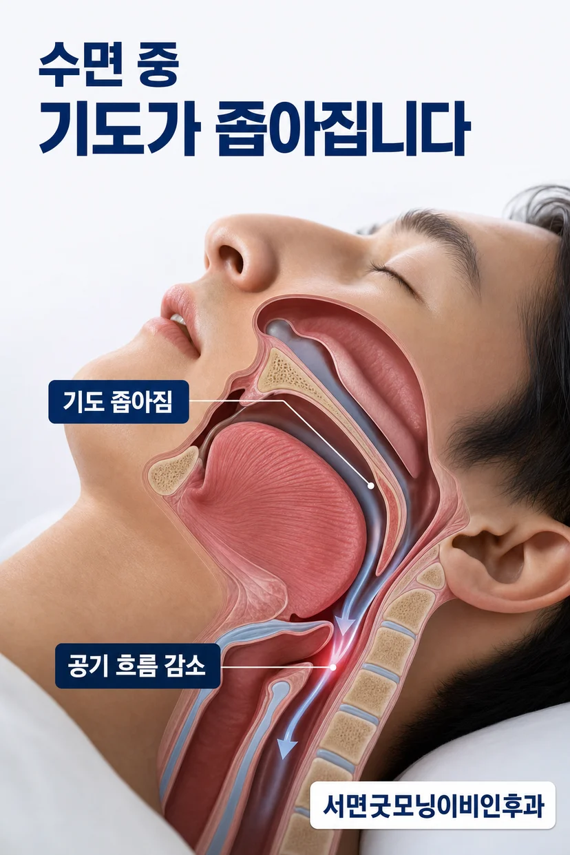 수면다원검사 결과 예시