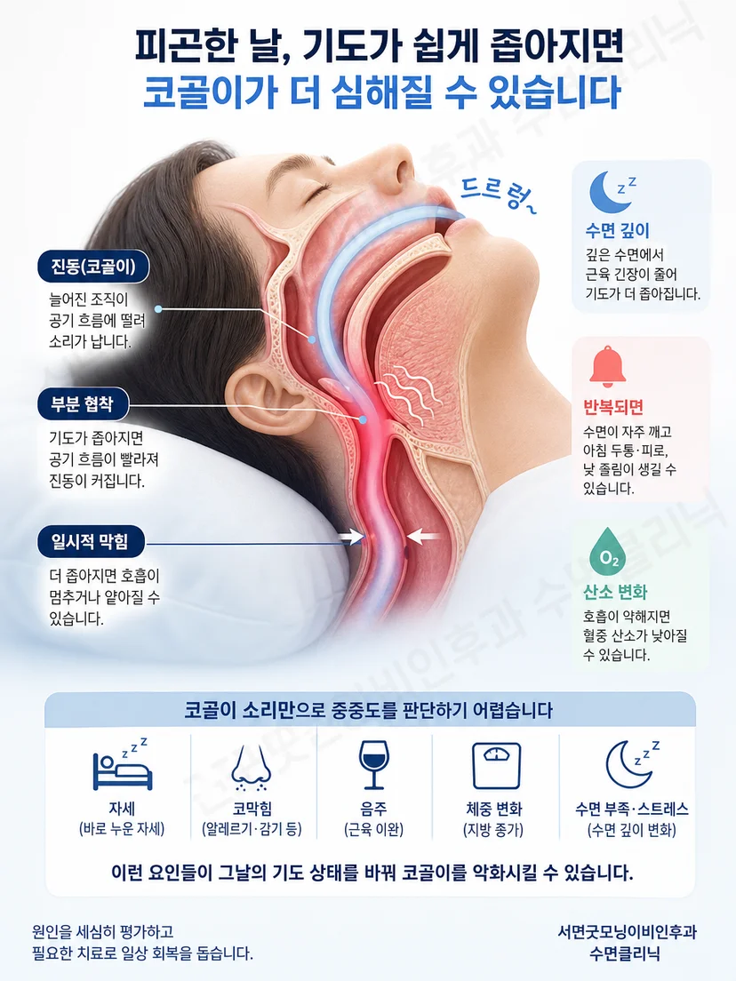 바로 누운 사람의 혀와 연구개 주변에서 좁아진 공기 통로를 보여주는 해부 그림