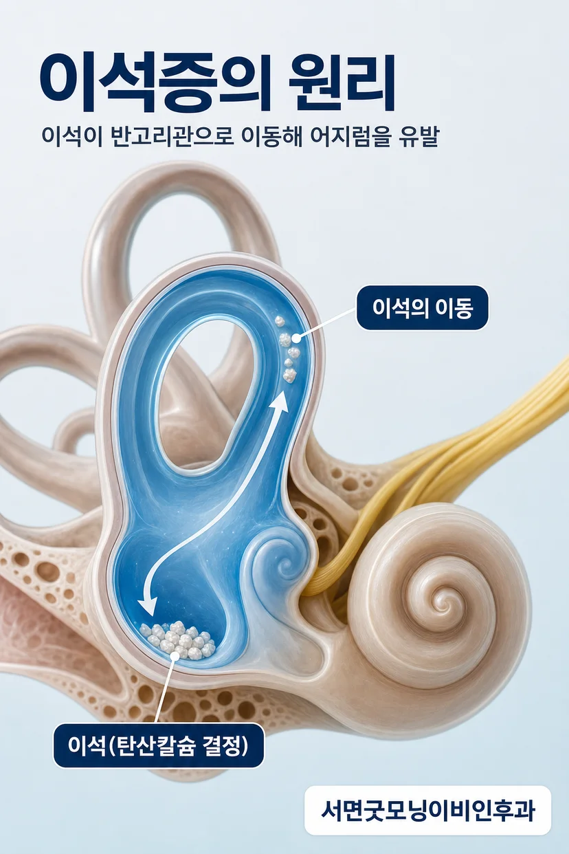 이석증 환자의 자세 변화와 어지럼 발생 상황