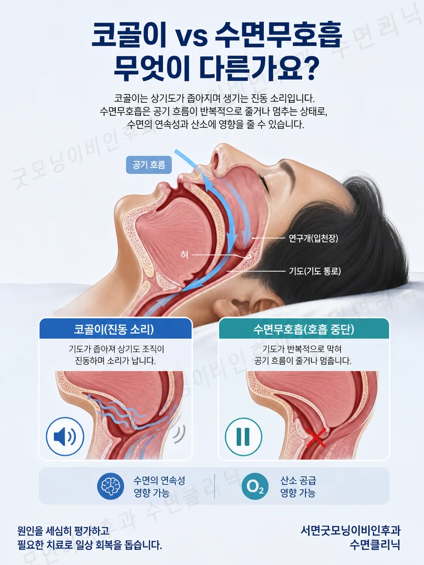 정상적으로 열린 상기도와 수면 중 좁아진 상기도를 나란히 나타낸 해부 그림
