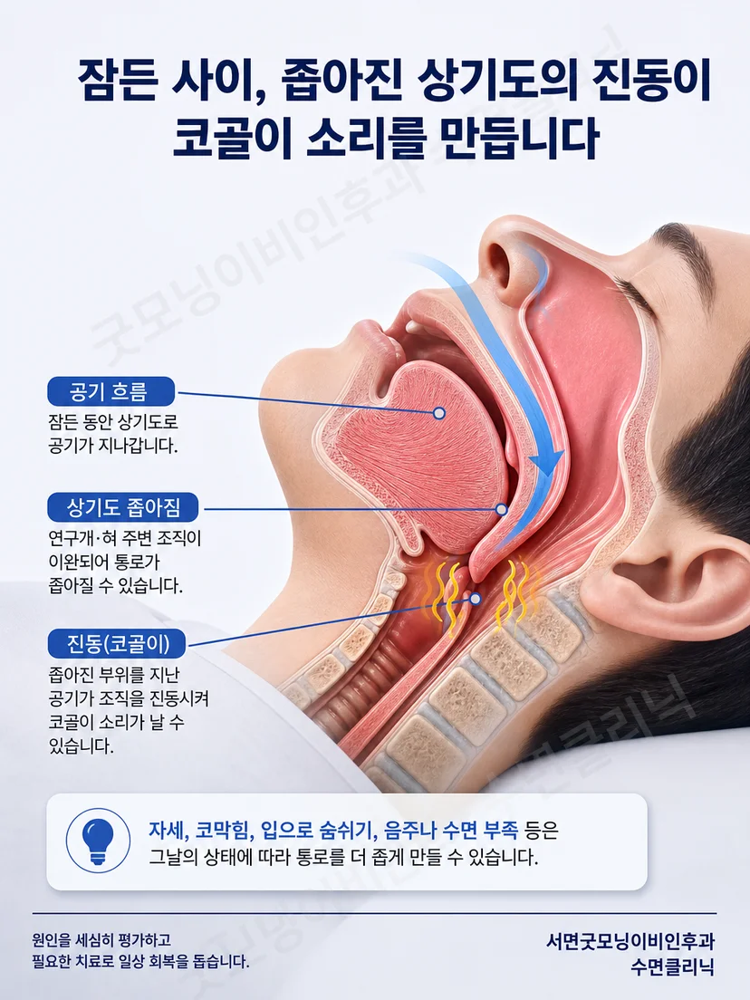 코막힘과 입호흡이 있을 때 코와 목을 지나는 공기 통로를 보여주는 해부 그림