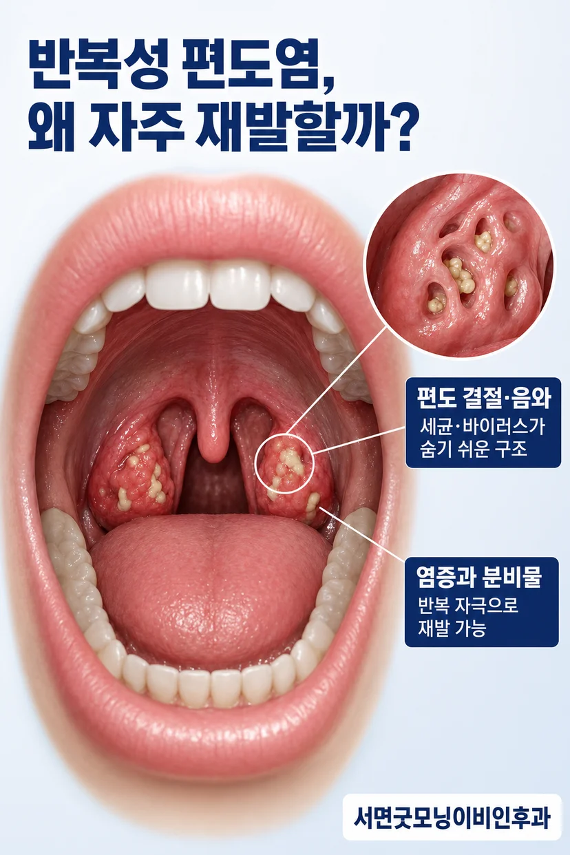 편도에 하얀 분비물이 보이는 사진