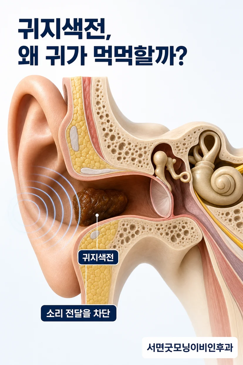귀지색전 증상 설명
