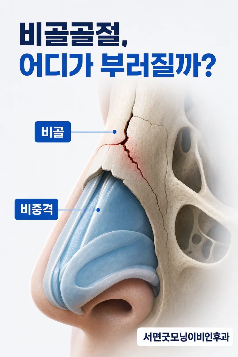 코뼈 골절의 해부학적 구조 설명