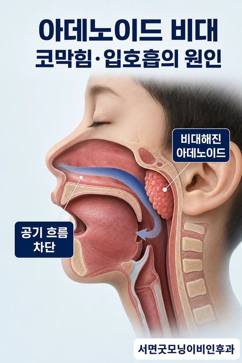 입호흡과 코골이로 인한 수면 문제