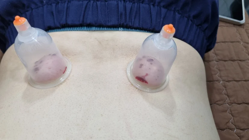 허리 부위에 사혈 부항 치료를 진행하는 사진