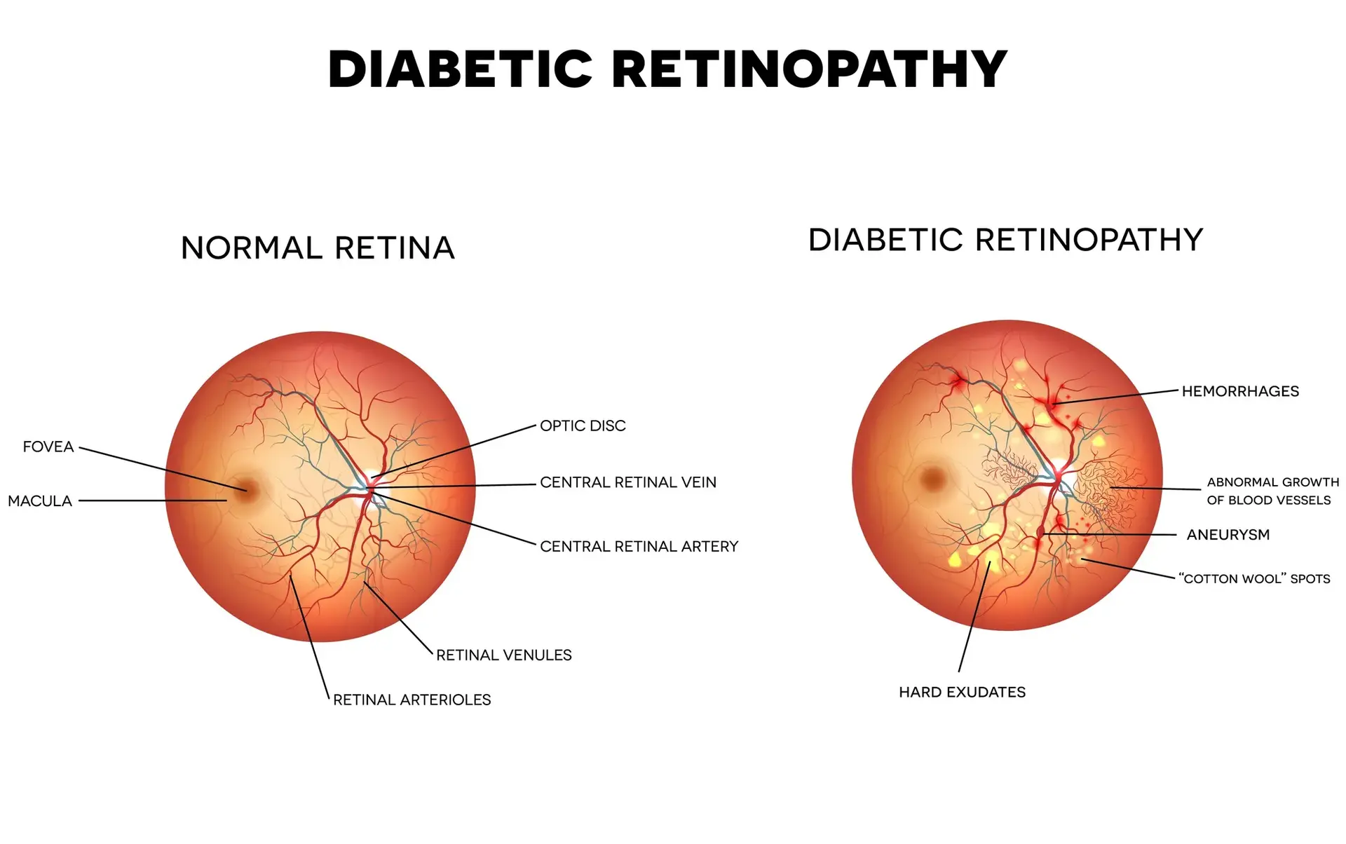 diabetic retinopathy, 당뇨망막병증
