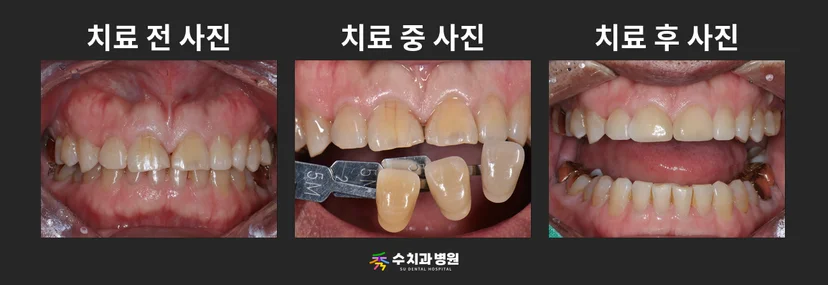 📸 치료 전후 비교 사진