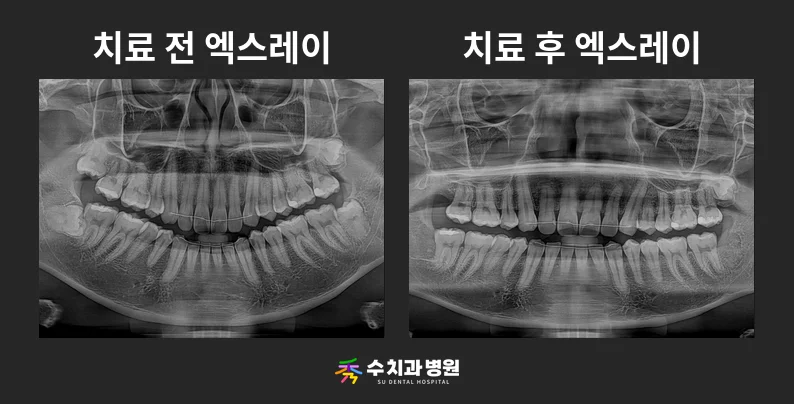 📸 치료 전후 비교 사진