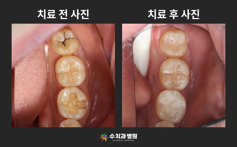 📸 치료 전후 비교 사진