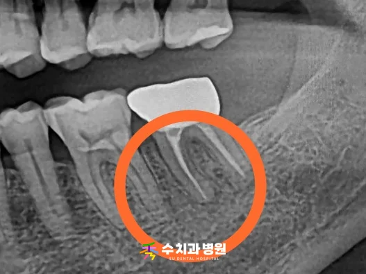 📸 치료 1년 2개월 후 엑스레이