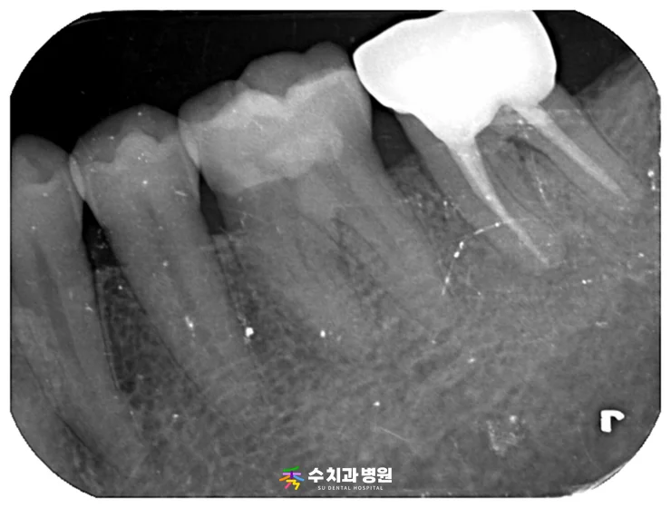 📸 치료 6개월 후 엑스레이
