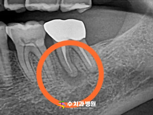 📸 치료 전 엑스레이