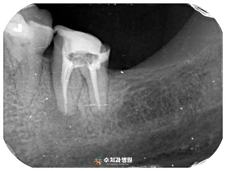 📸 치료 중(신경치료 후) 엑스레이