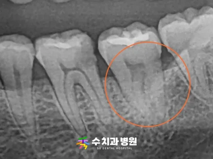 📸 치료 전 엑스레이