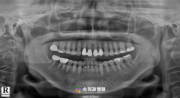 📸 치료 전 엑스레이