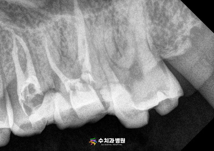 📸 치료 전(신경치료 후) 엑스레이