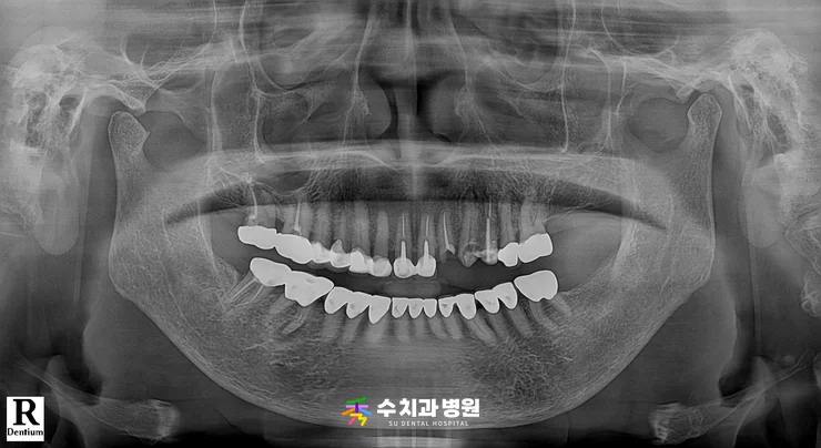 📸 치료 전 엑스레이