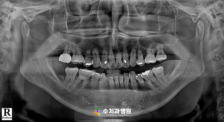 📸 치료 전 엑스레이