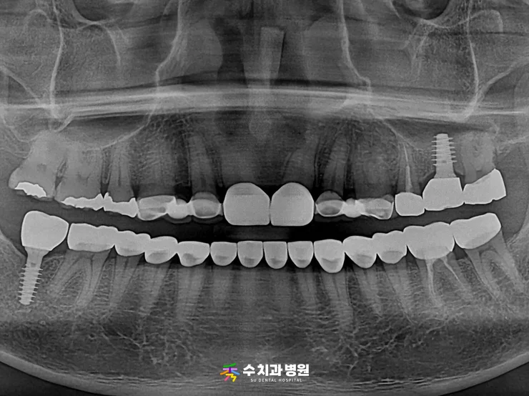 📸 치료 1년 6개월 후 엑스레이