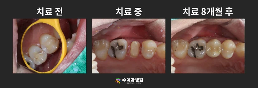 📸 치료 전후 비교 사진
