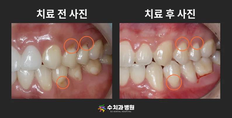 📸 치료 전후 비교 사진