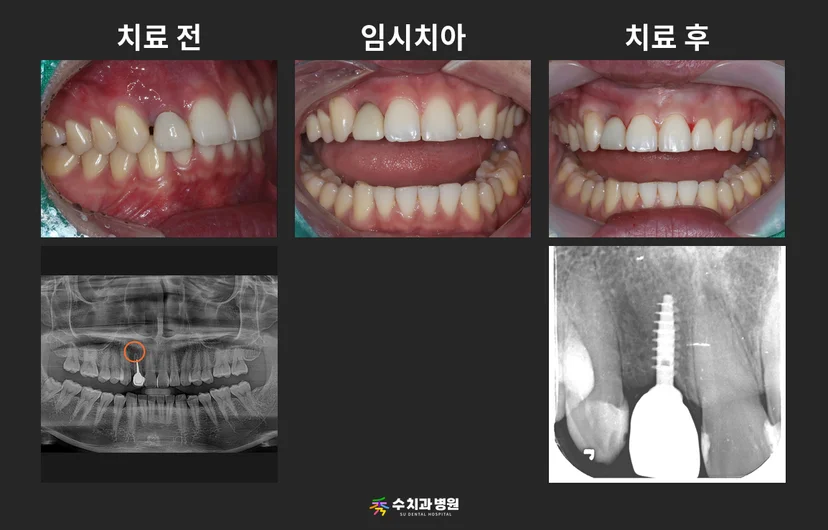 📸 치료 전후 비교 사진